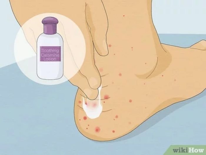 6 Cara Mengobati Gigitan Serangga Berair - Photo by wikiHow