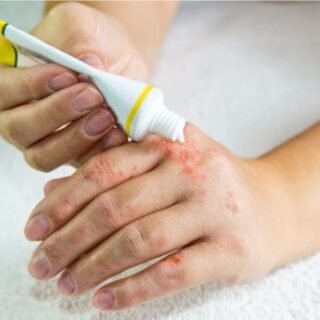 Cara Mengobati Gigitan Serangga Berair - Photo by Google