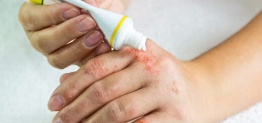 Cara Mengobati Gigitan Serangga Berair - Photo by Google