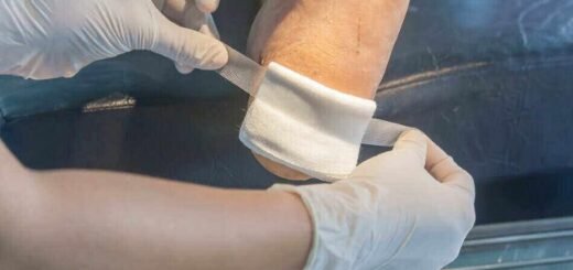 Cara Mengobati Luka Berair Agar Cepat Kering - Photo by Google