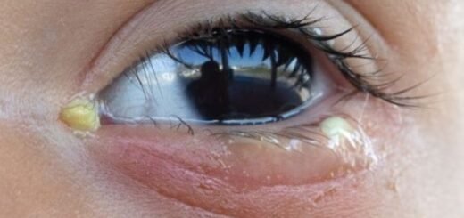 Cara Mengobati Sakit Mata Belekan Secara Medis dan Alami - Photo by Google