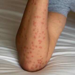 Obat Gigitan Serangga Bengkak dan Gatal Yang Ampuh - Photo by Google