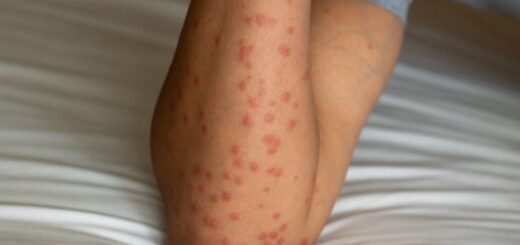 Obat Gigitan Serangga Bengkak dan Gatal Yang Ampuh - Photo by Google