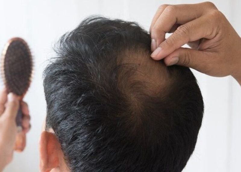 6 Obat Tradisional Penumbuh Rambut Yang Aman - KATA OMED