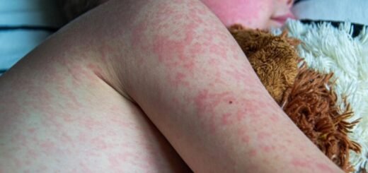 9 Cara Mudah Mengobati Penyakit Campak Secara Tepat - Photo by Google